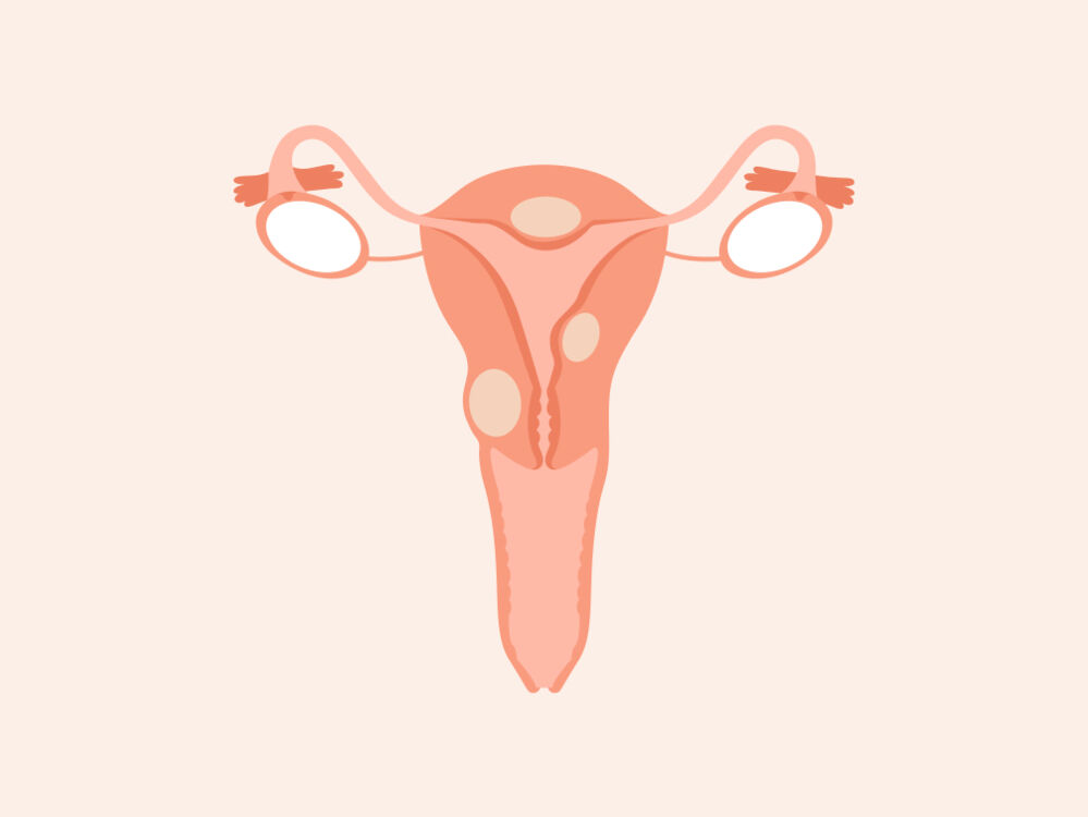 fibroids-what-do-they-feel-like-and-do-they-go-away